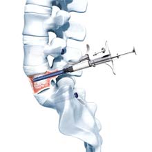 Auffüllung des osteoporotischen Wirbelkörpers mit Knochenzement im Rahmen einer Stabilisierung bei Osteoporose als Nebenerkrankung © Synthes
